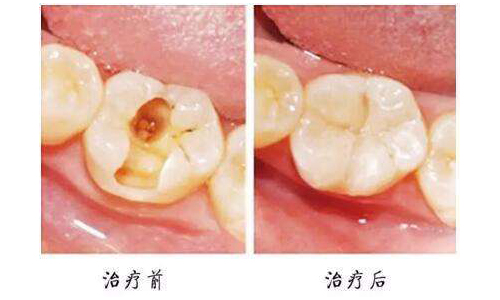 龋病充填后可能出现哪些问题